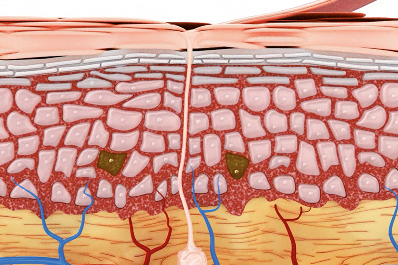 Schaubild: Zusätzliche Zellen in der untersten Hautschicht