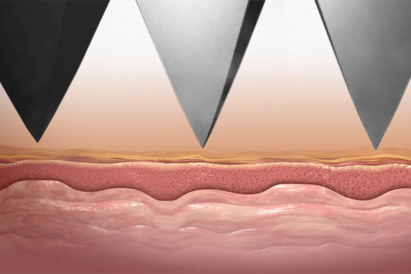 Wirkungsweise des Mezotix®-Verfahrens: Titanpyramiden vor dem Hautkontakt