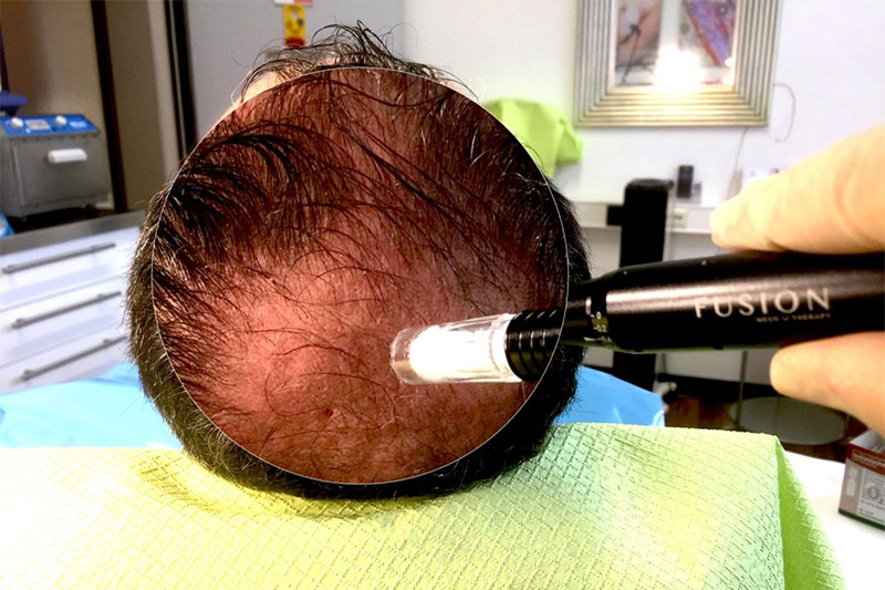 Eine Microneedling-Behandlung MESO-FUSION-HAIR auf der Kopfhaut