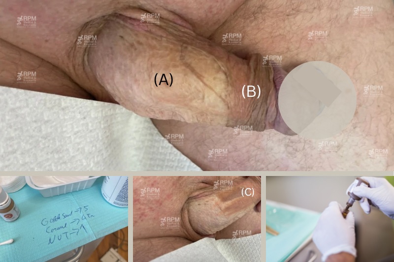 Farbangleichung Pigmentierung von Spalthaut am Penis - Penisschaft